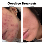 Acne Reduction Skincare Bundle - cieme